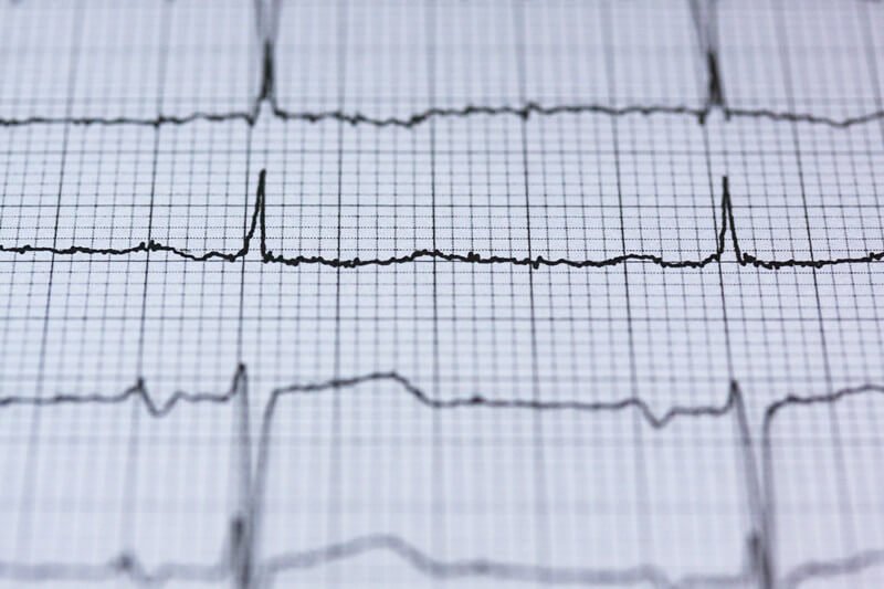 ECG paper 101